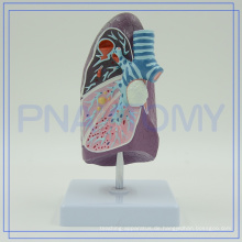 PNT-0732 Pathologisches Modell der Bronchien pulmonales, biologisches Modell